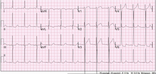 Senkop Hastasında Korkulması Gereken Hipertrofik EKG